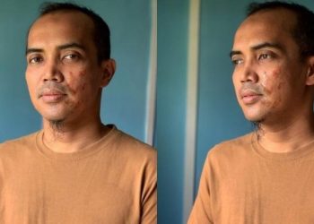 “Kejamnya, Sampai Melecur Muka!” – Pipi Ezad Lazim Cedera Gara-gara Disimbah Air Panas