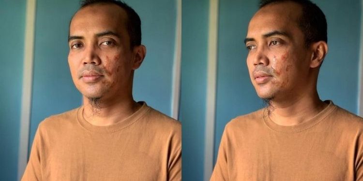 “Kejamnya, Sampai Melecur Muka!” – Pipi Ezad Lazim Cedera Gara-gara Disimbah Air Panas