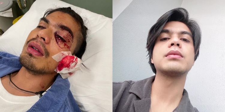 [VIDEO] “Saya Hampir Buta” – Terlibat Kemalangan, Ben Amir Jalani Pembedahan