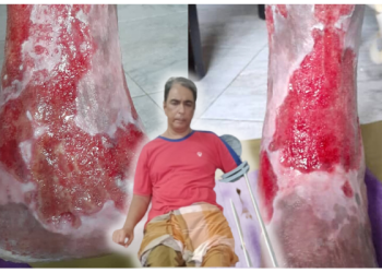 Tujuh Tahun Derita Ulser Kulit, Keluarga Buntu Cari Penawar – “Kewangan Kami Pun Habis”