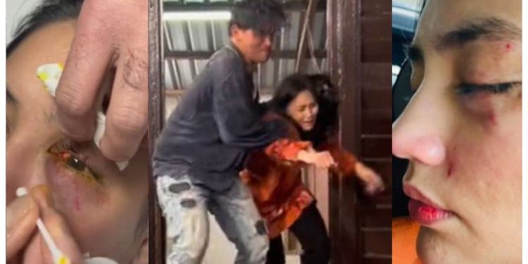 [V] Tulang Mata Kiri Fasha Retak, Tergelincir Ketika Lakon Aksi Dibantai Azhan Rani