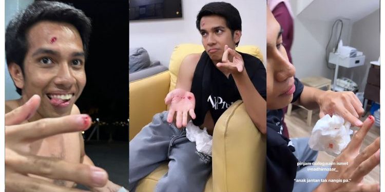 Gara-gara Bermain Mercun Bola, Naim Daniel Luka Di Dahi Dan Tapak Tangan Selain Kuku Jari Pecah