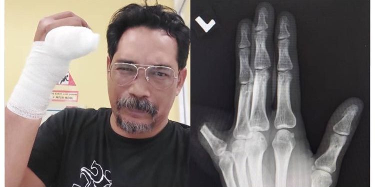 Pisau Tersasar Sewaktu Potong Ayam, Pelakon Shahronizam Reda Kehilangan Jari Kelingking