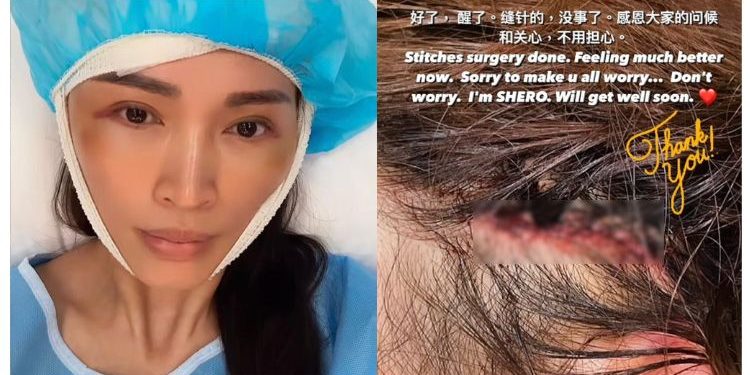 Jatuh Tangga, Amber Chia Selesai Jalani Pembedahan Kepala – “Saya OK, Semua Selesai…”