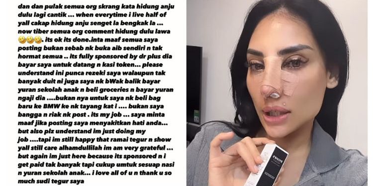Anju Mohon Maaf Selepas Pembedahan Hidung