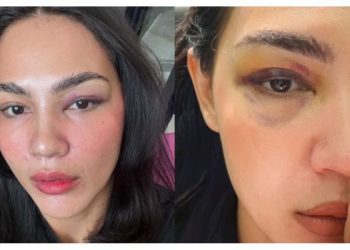 “Tak, Saya Tak Kena Tumbuk!” – Nadia Brian Jatuh, Mata Lebam Akibat ‘Crash Diet’