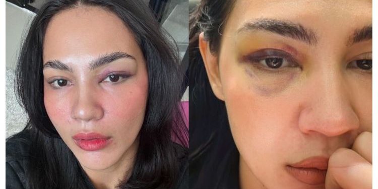 “Tak, Saya Tak Kena Tumbuk!” – Nadia Brian Jatuh, Mata Lebam Akibat ‘Crash Diet’
