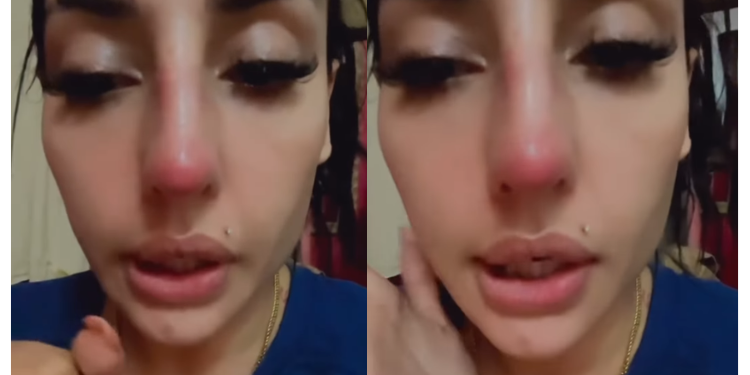 “Infected, Fever & Body Aches!” – Zarina Anjoulie Regrets Getting Nose Job In Vietnam
